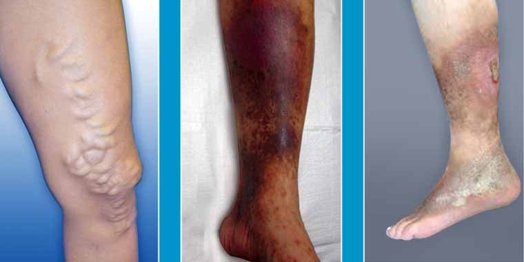 Varicose Vein Treatment