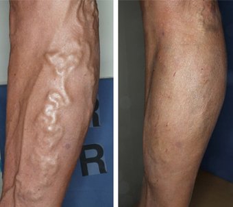 before-after varicose veins