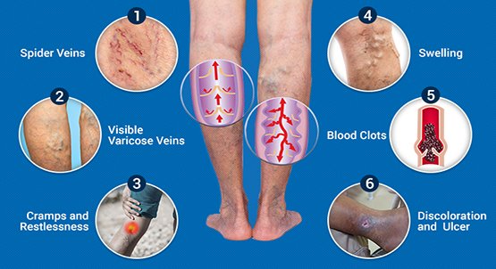 KNOW THE SIGNS OF VEIN DISEASE BEFORE IT PROGRESSES - Varicose Veins Care  Center