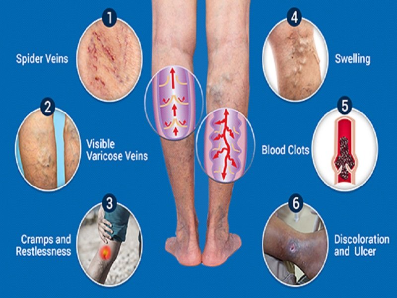 The Developmental Stages of Varicose Veins - Vein Artery