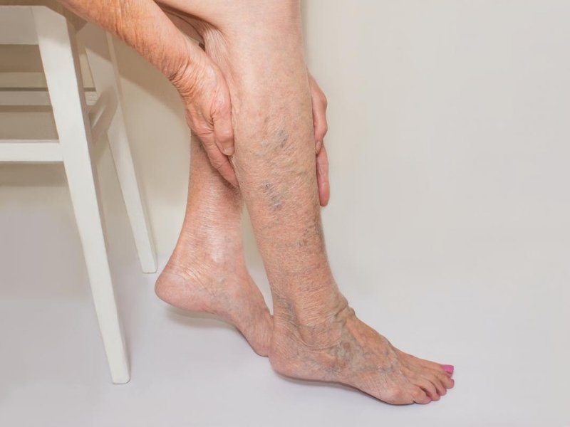 LEG VEINS: WHY THEY APPEAR AND HOW DERMATOLOGISTS TREAT THEM